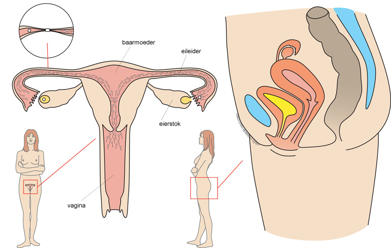 Sterilisatie bij de vrouw